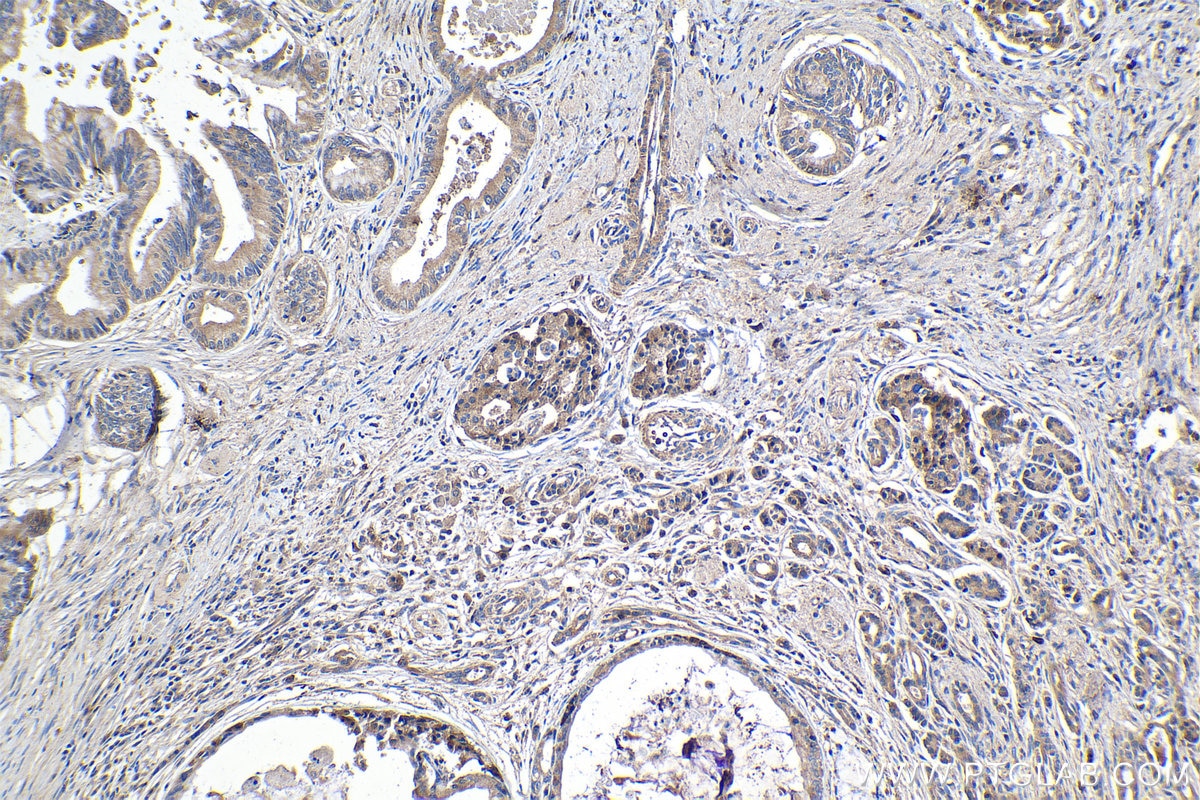 Immunohistochemical analysis of paraffin-embedded human pancreas cancer tissue slide using KHC1070 (CX3CL1 IHC Kit).