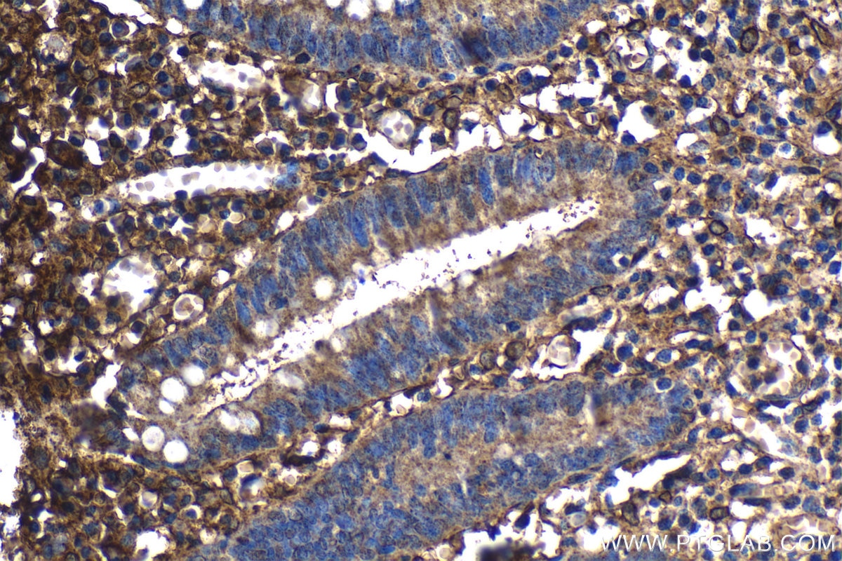 Immunohistochemical analysis of paraffin-embedded human appendicitis tissue slide using KHC1297 (CXCL10/IP10 IHC Kit).