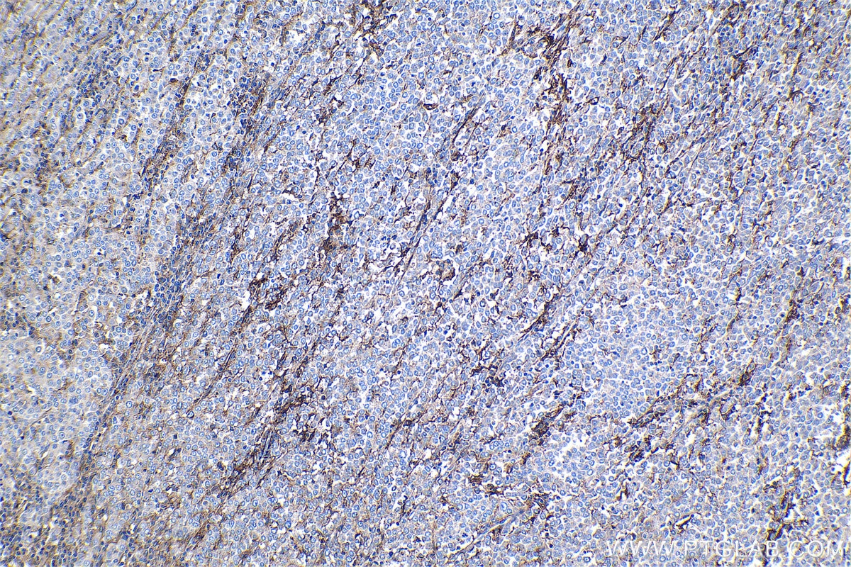 Immunohistochemical analysis of paraffin-embedded human ovary tumor tissue slide using KHC1297 (CXCL10/IP10 IHC Kit).