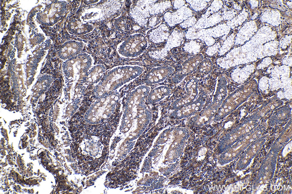 Immunohistochemical analysis of paraffin-embedded human stomach cancer tissue slide using KHC1297 (CXCL10/IP10 IHC Kit).
