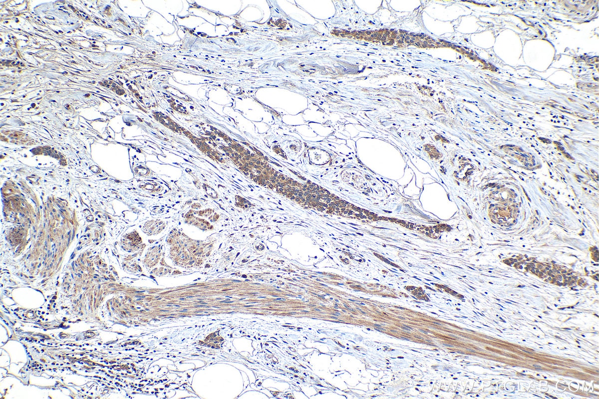 Immunohistochemical analysis of paraffin-embedded human urothelial carcinoma tissue slide using KHC1246 (CXCL5 IHC Kit).