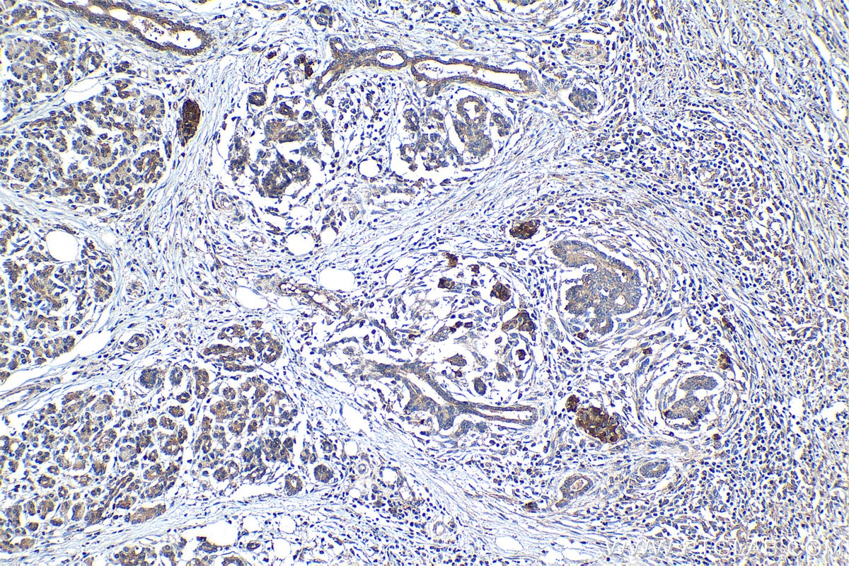 Immunohistochemical analysis of paraffin-embedded human pancreas cancer tissue slide using KHC1246 (CXCL5 IHC Kit).