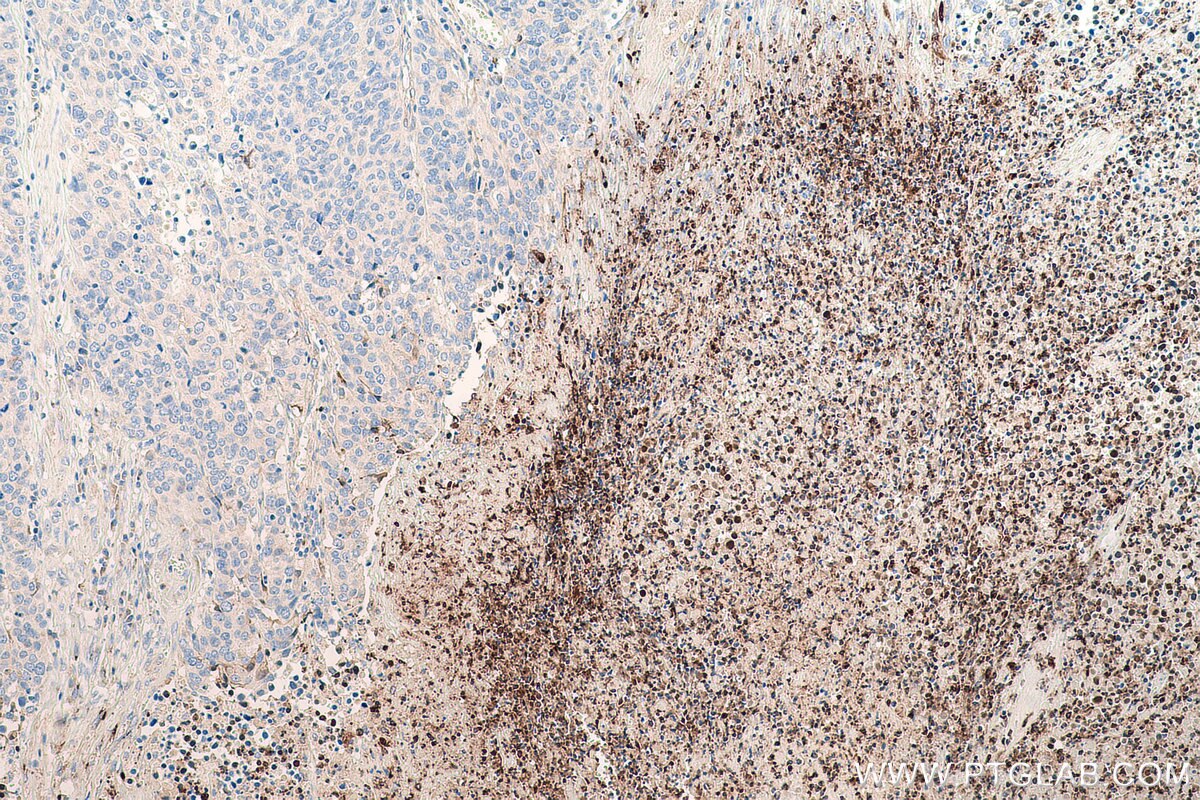 Immunohistochemical analysis of paraffin-embedded human stomach cancer tissue slide using KHC0801 (CXCL8/IL-8 IHC Kit).