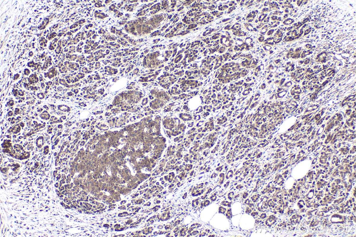 Immunohistochemical analysis of paraffin-embedded human pancreas cancer tissue slide using KHC1799 (CXXC5 IHC Kit).