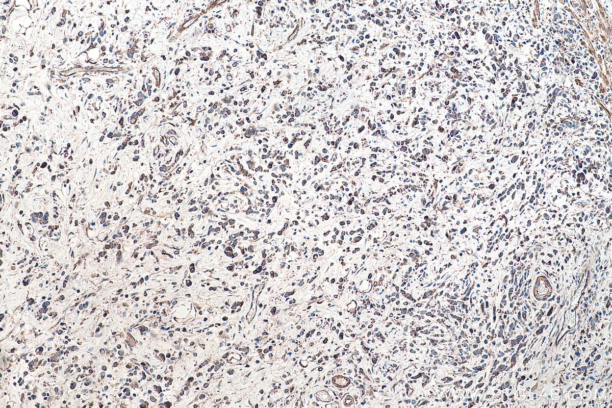 Immunohistochemical analysis of paraffin-embedded human stomach cancer tissue slide using KHC0521 (CYB5A IHC Kit).