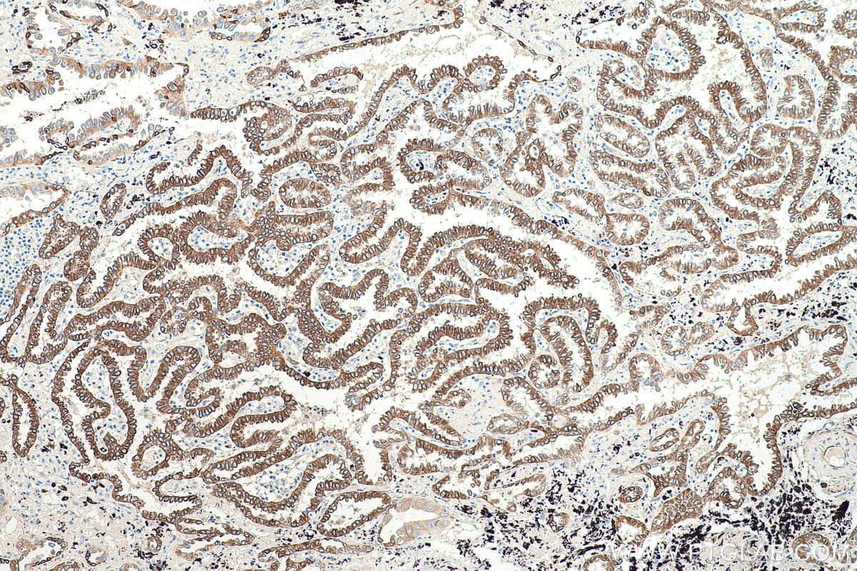Immunohistochemical analysis of paraffin-embedded human lung cancer tissue slide using KHC0521 (CYB5A IHC Kit).