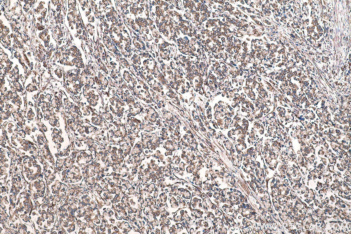 Immunohistochemical analysis of paraffin-embedded human colon cancer tissue slide using KHC0699 (CYB5R3 IHC Kit).