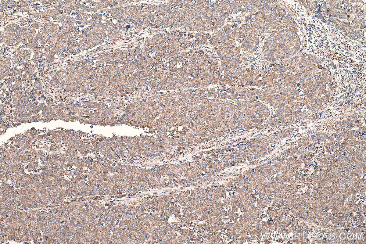 Immunohistochemical analysis of paraffin-embedded human stomach cancer tissue slide using KHC0699 (CYB5R3 IHC Kit).