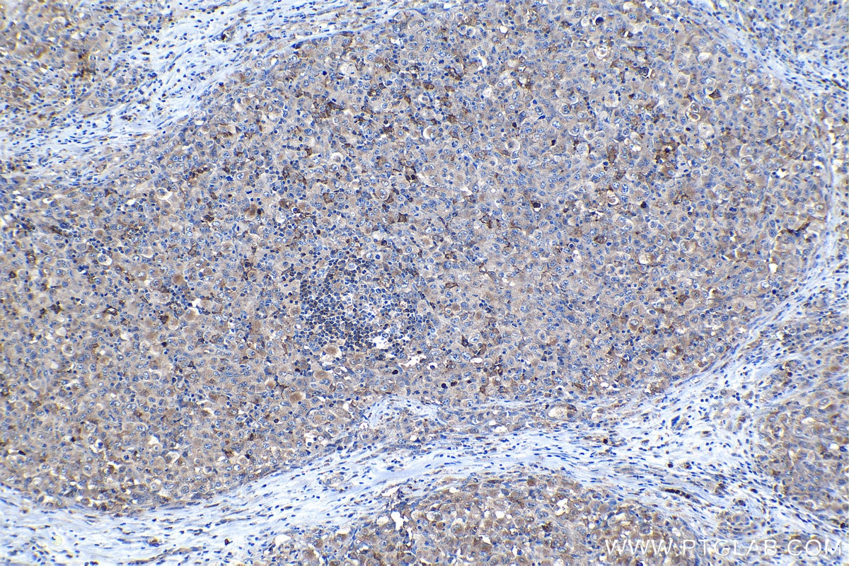 Immunohistochemical analysis of paraffin-embedded human lymphoma tissue slide using KHC1126 (CYBA IHC Kit).