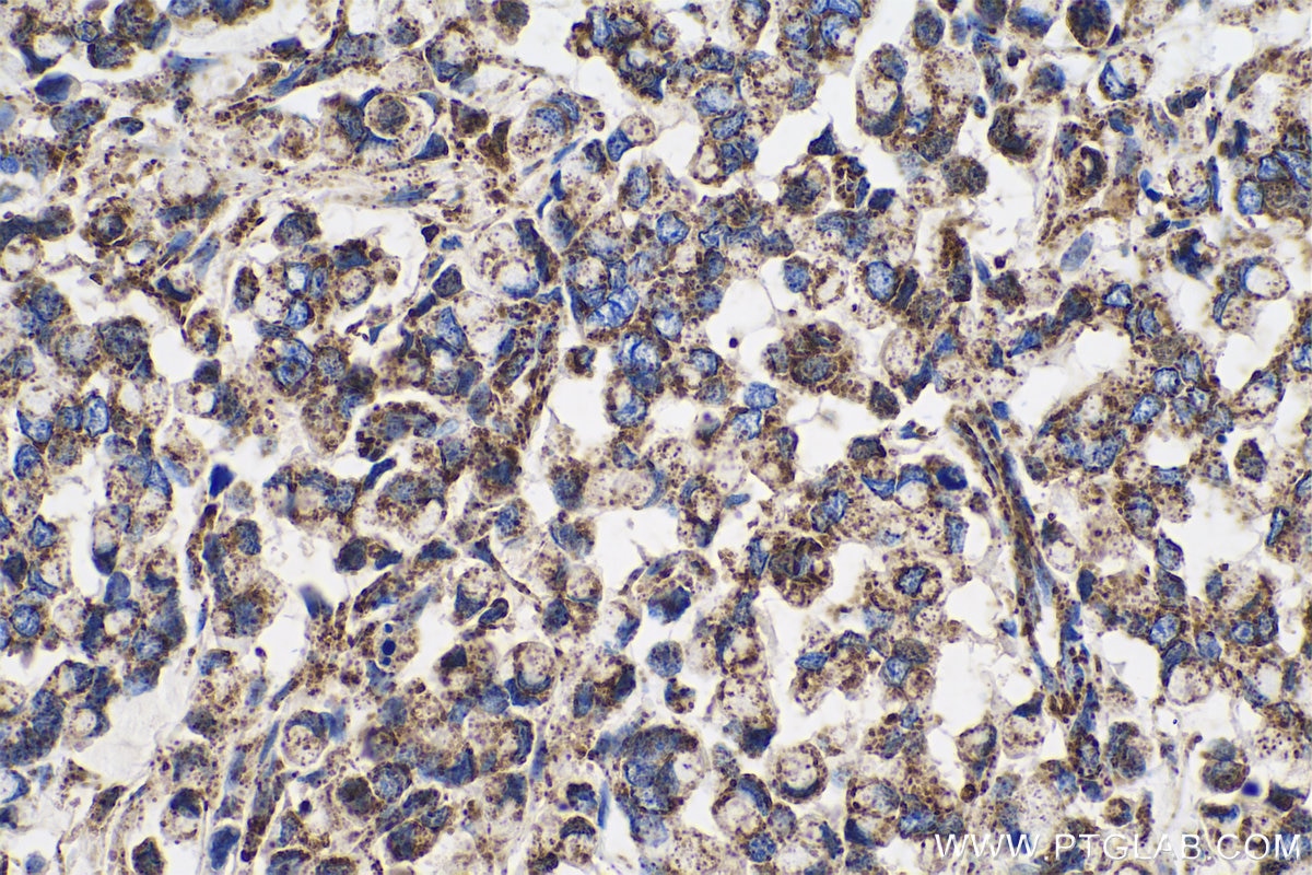 Immunohistochemical analysis of paraffin-embedded human colon cancer tissue slide using KHC0715 (CYCS IHC Kit).