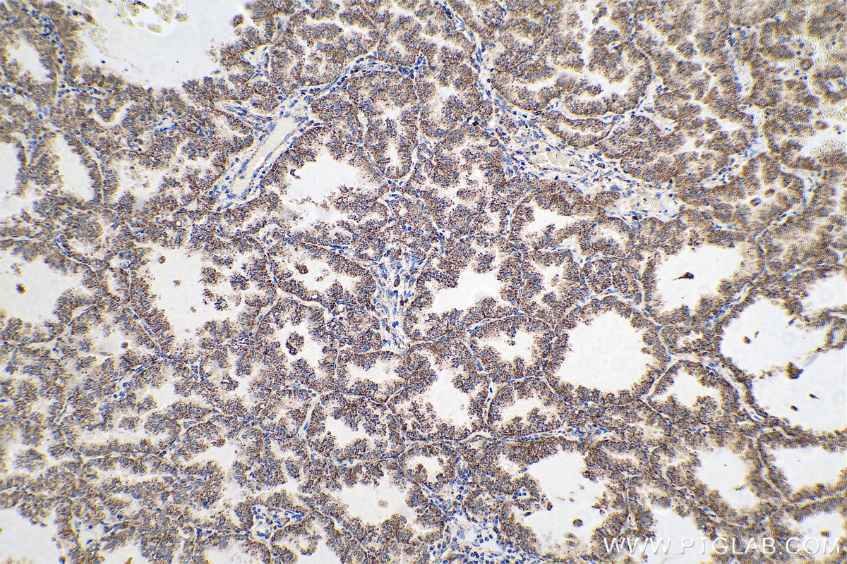 Immunohistochemical analysis of paraffin-embedded human lung cancer tissue slide using KHC0715 (CYCS IHC Kit).