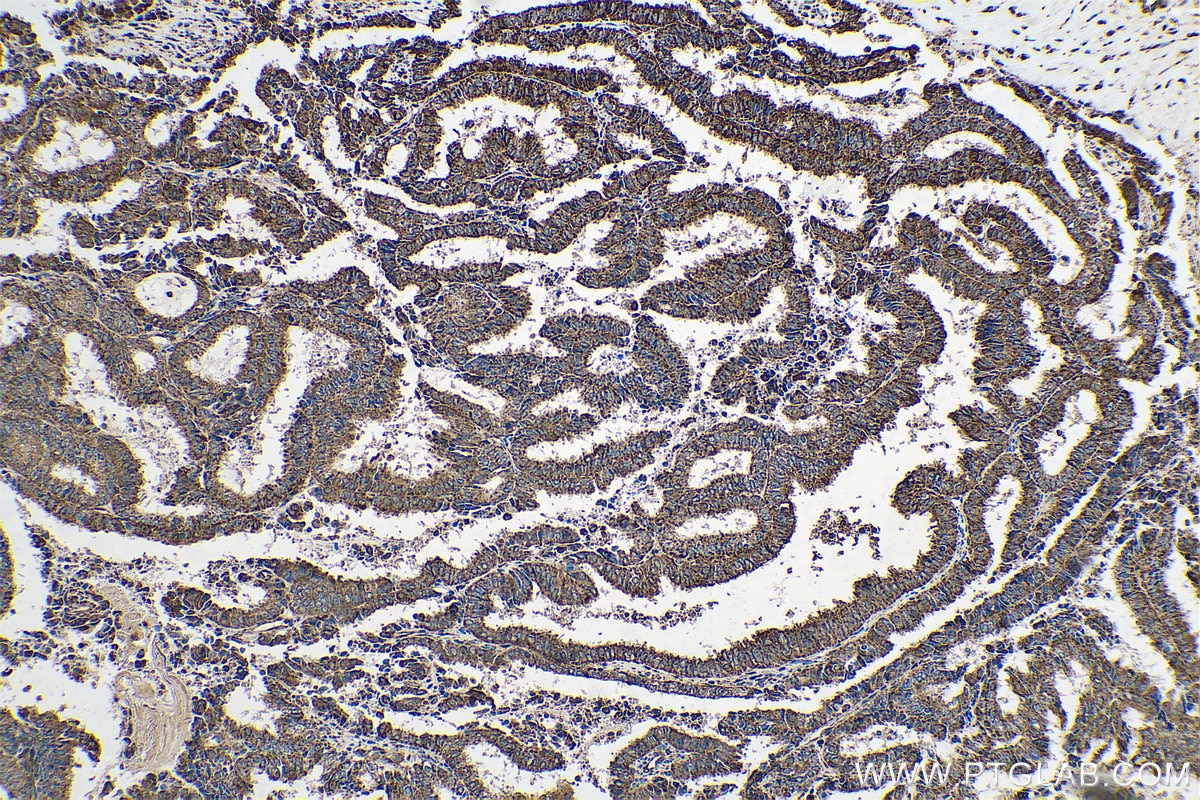 Immunohistochemical analysis of paraffin-embedded human ovary tumor tissue slide using KHC0715 (CYCS IHC Kit).