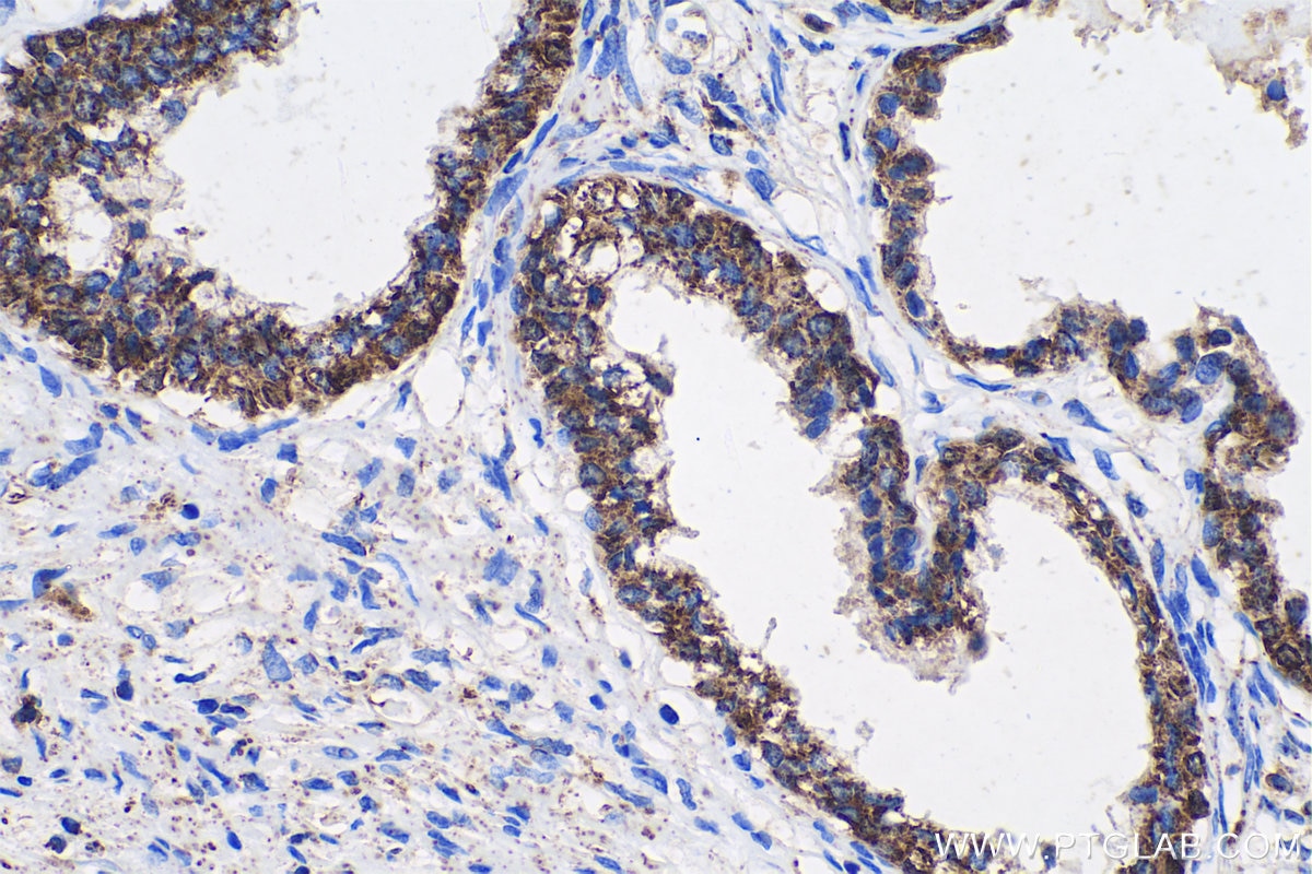 Immunohistochemical analysis of paraffin-embedded human prostate cancer tissue slide using KHC0715 (CYCS IHC Kit).