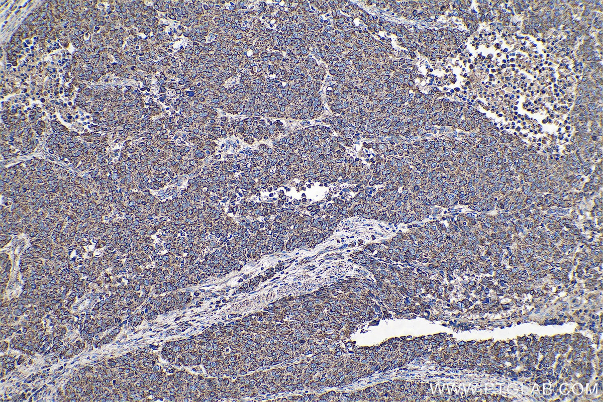 Immunohistochemical analysis of paraffin-embedded human stomach cancer tissue slide using KHC0715 (CYCS IHC Kit).