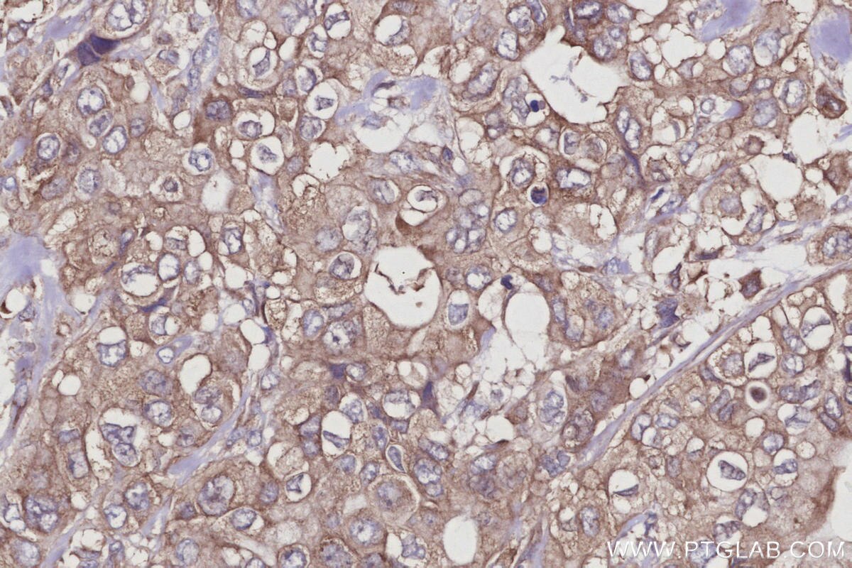 Immunohistochemical analysis of paraffin-embedded human pancreas cancer tissue slide using KHC2940 (CYLD IHC Kit).
