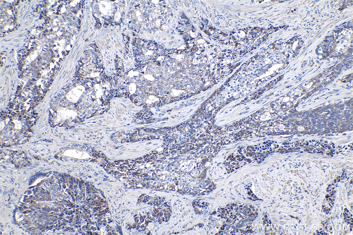 Immunohistochemical analysis of paraffin-embedded human prostate hyperplasia tissue slide using KHC1085 (CYP17A1 IHC Kit).