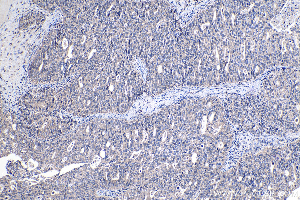 Immunohistochemical analysis of paraffin-embedded human ovary tumor tissue slide using KHC1085 (CYP17A1 IHC Kit).
