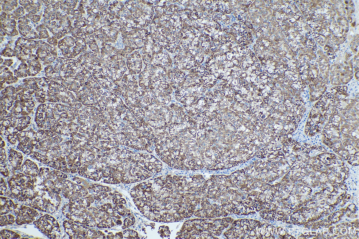 Immunohistochemical analysis of paraffin-embedded human liver cancer tissue slide using KHC0494 (CYP27A1 IHC Kit).