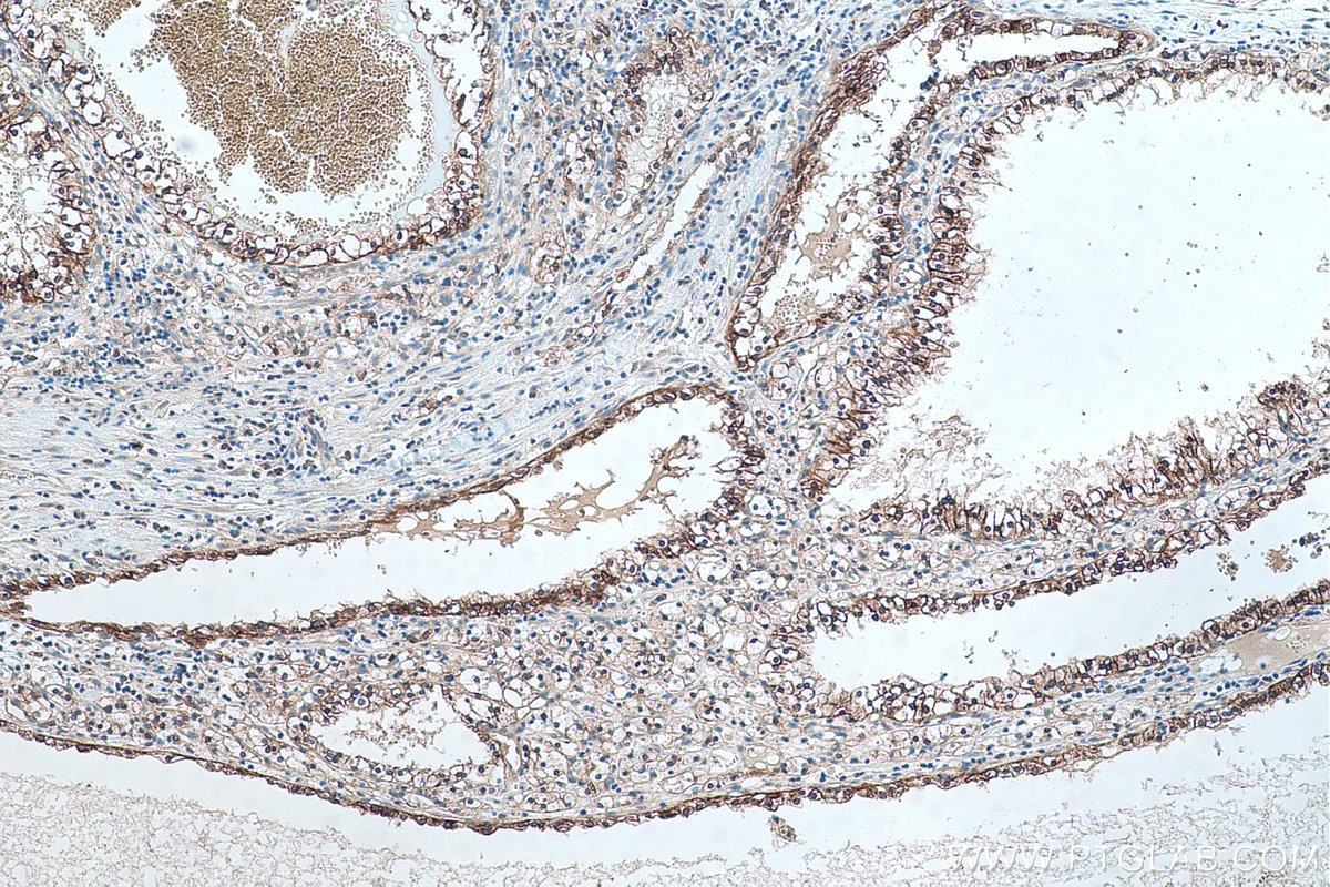 Immunohistochemical analysis of paraffin-embedded human renal cell carcinoma tissue slide using KHC0413 (CYP2J2 IHC Kit).