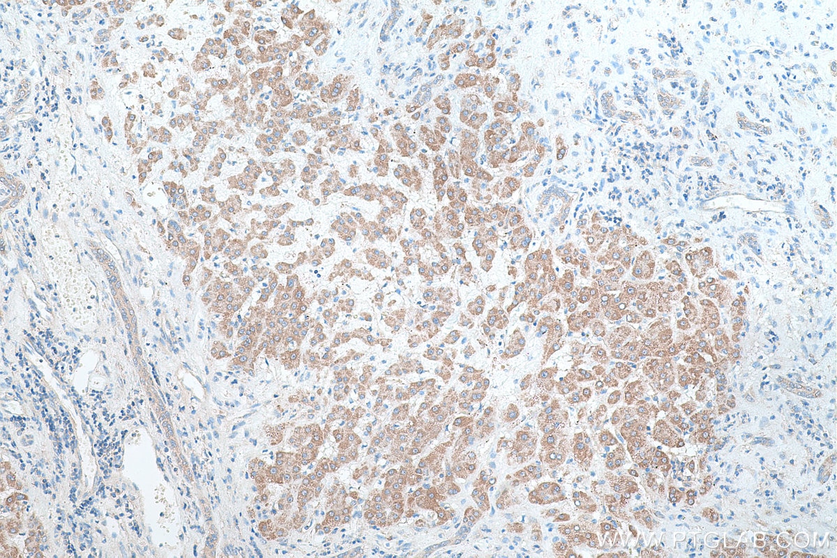 Immunohistochemical analysis of paraffin-embedded human liver cancer tissue slide using KHC0413 (CYP2J2 IHC Kit).