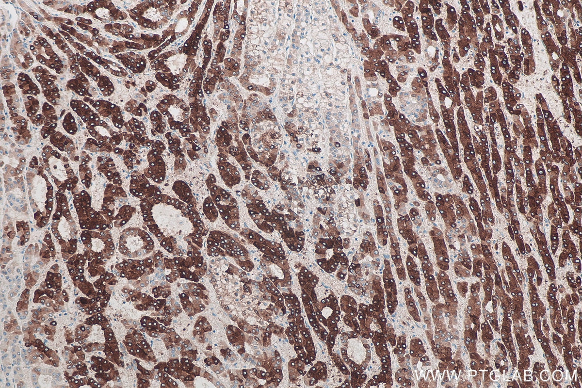 Immunohistochemical analysis of paraffin-embedded human liver cancer tissue slide using KHC0387 (CYP3A4 IHC Kit).