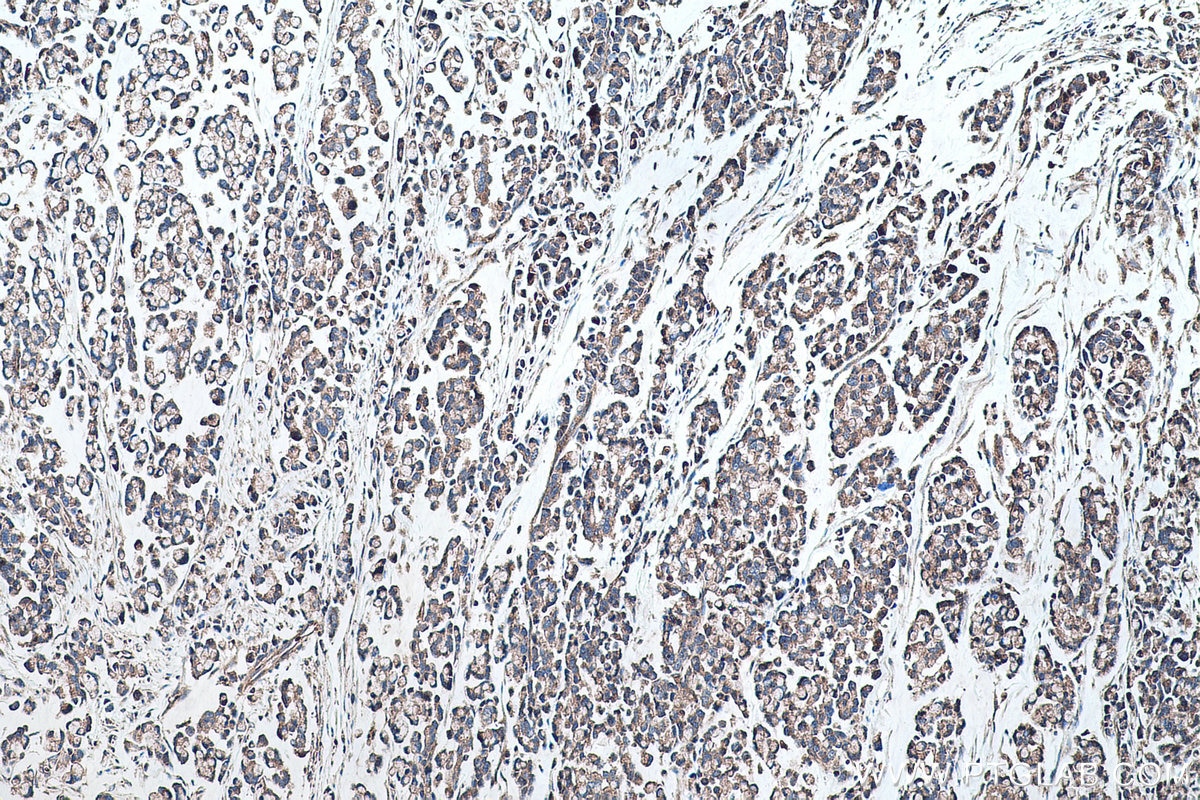 Immunohistochemical analysis of paraffin-embedded human colon cancer tissue slide using KHC0486 (CYP7B1 IHC Kit).