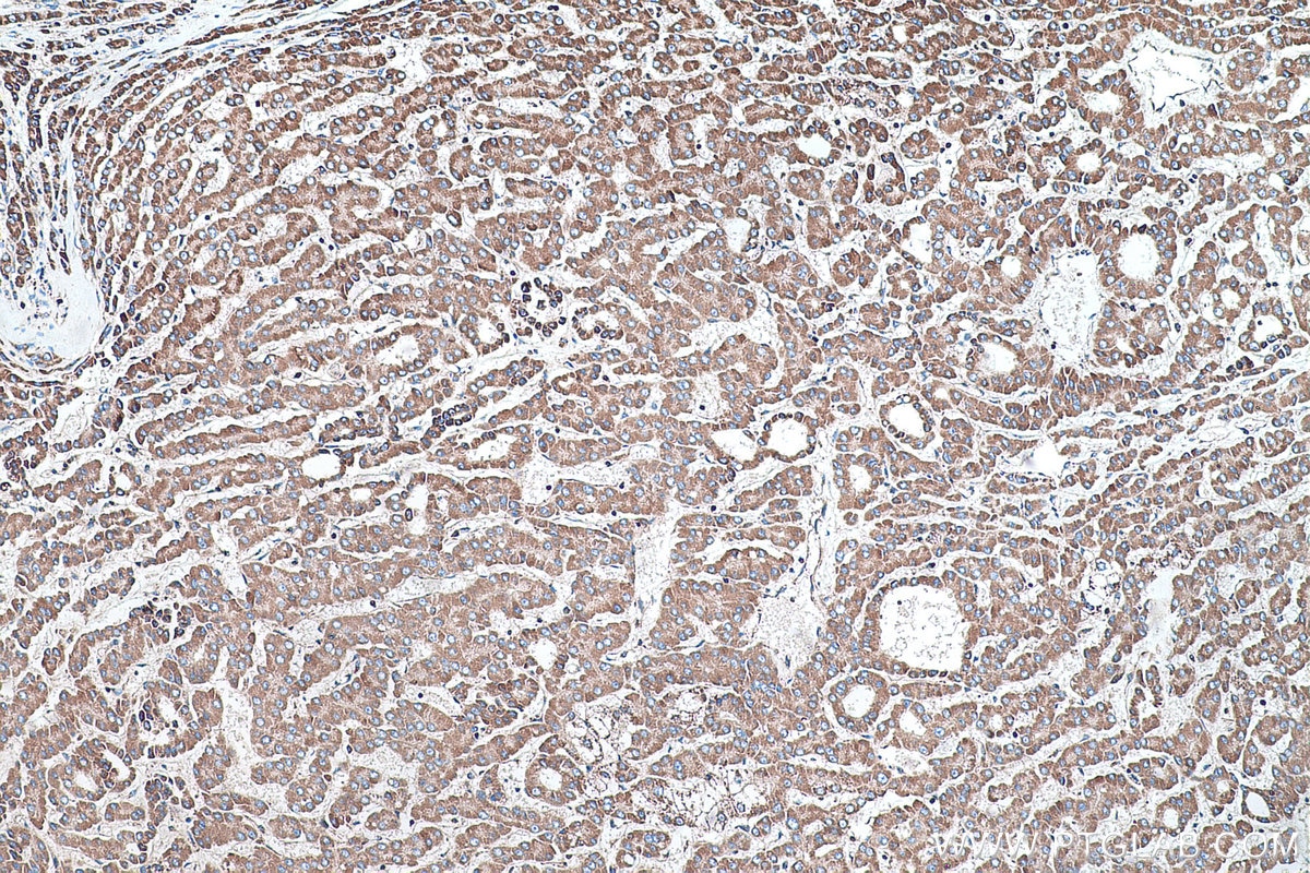 Immunohistochemical analysis of paraffin-embedded human liver cancer tissue slide using KHC0486 (CYP7B1 IHC Kit).