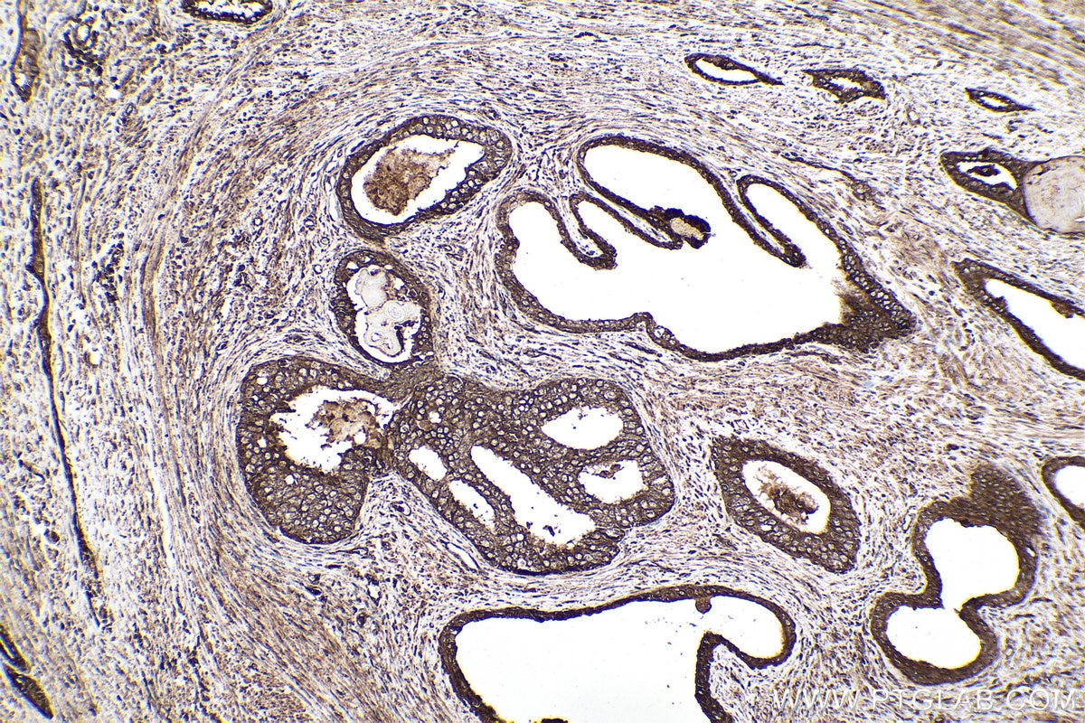 Immunohistochemical analysis of paraffin-embedded human prostate cancer tissue slide using KHC0110 (CYR61 IHC Kit).