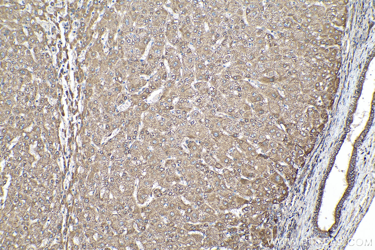 Immunohistochemical analysis of paraffin-embedded human liver cancer tissue slide using KHC0110 (CYR61 IHC Kit).