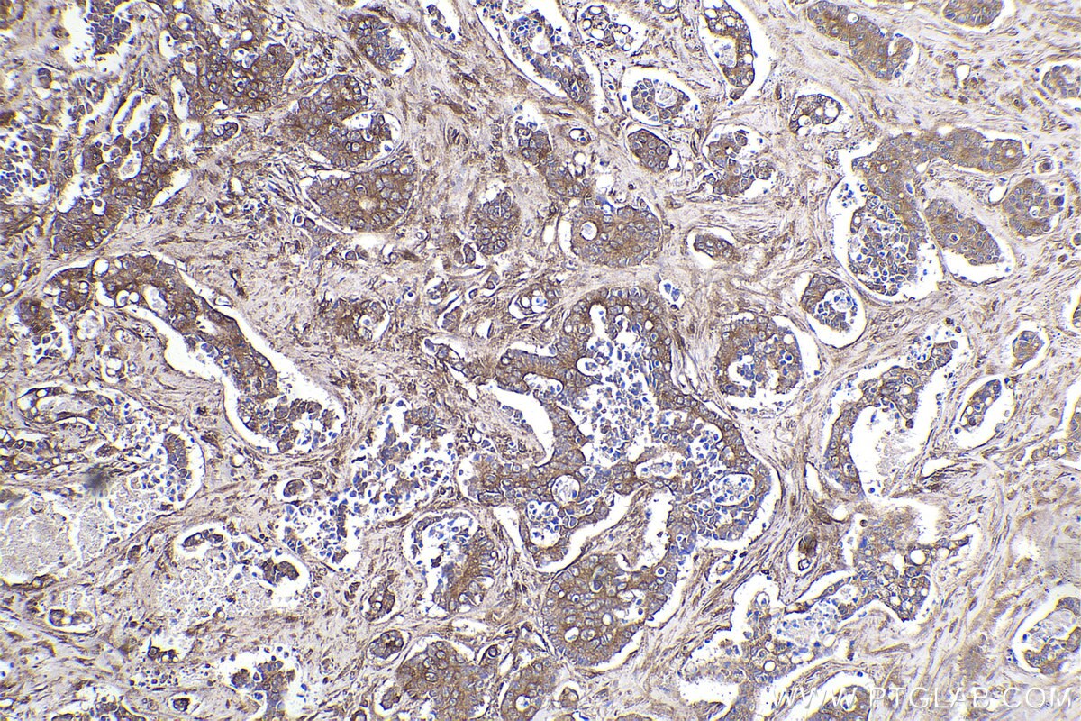 Immunohistochemical analysis of paraffin-embedded human stomach cancer tissue slide using KHC2187 (CALM3 IHC Kit).