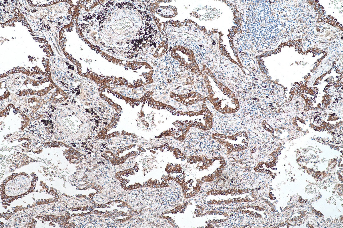 Immunohistochemical analysis of paraffin-embedded human lung cancer tissue slide using KHC0572 (Calnexin IHC Kit).