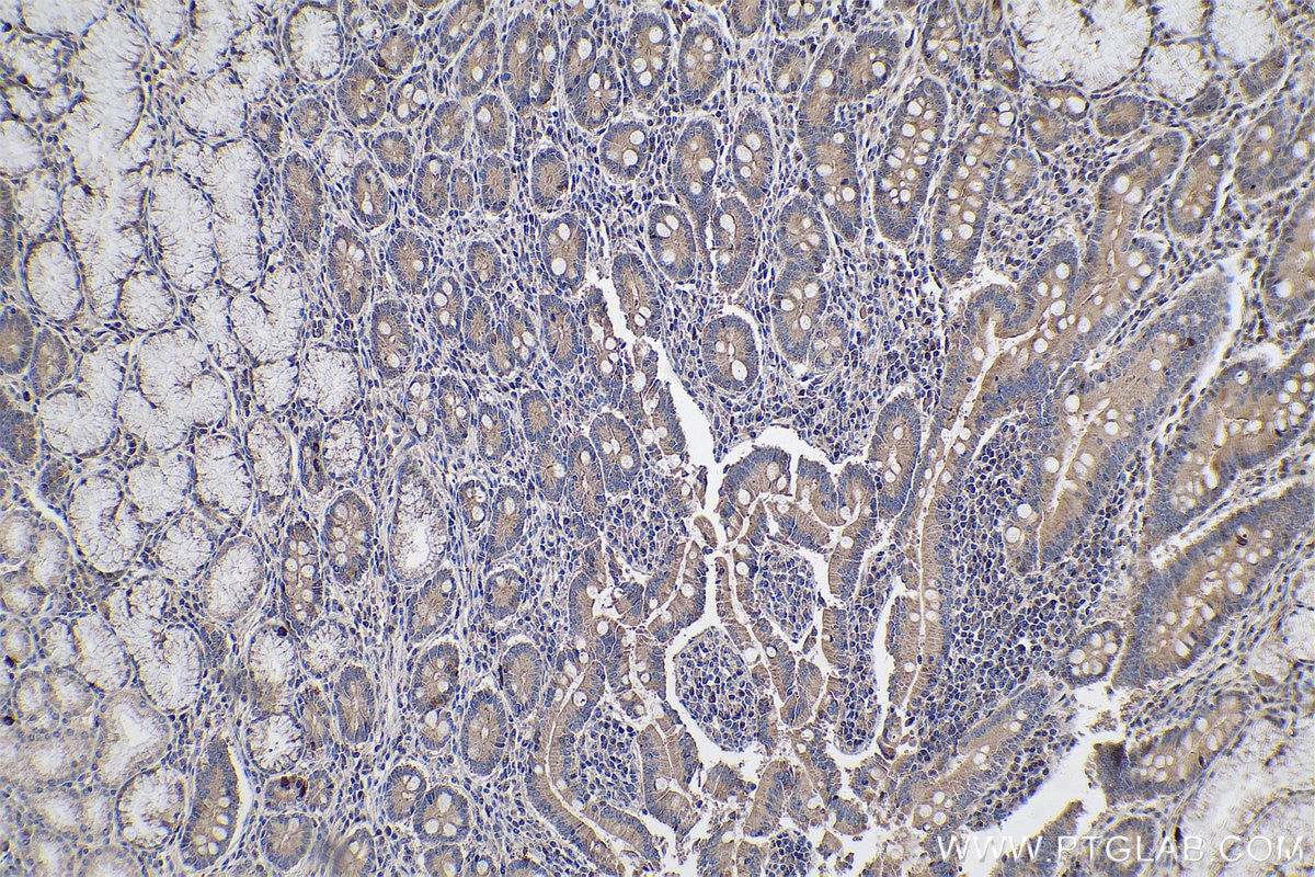 Immunohistochemical analysis of paraffin-embedded human stomach cancer tissue slide using KHC0606 (Caspase 2/p32/p18 IHC Kit).