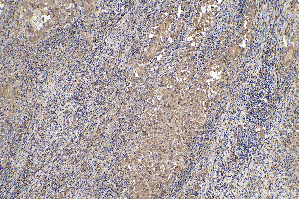 Immunohistochemical analysis of paraffin-embedded human cervical cancer tissue slide using KHC0373 (Cathepsin B IHC Kit).