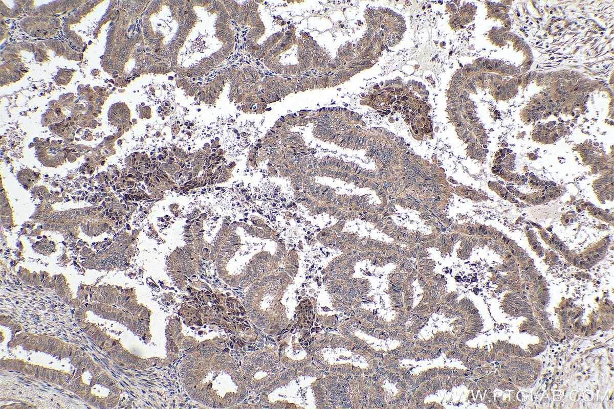 Immunohistochemical analysis of paraffin-embedded human ovary tumor tissue slide using KHC0373 (Cathepsin B IHC Kit).