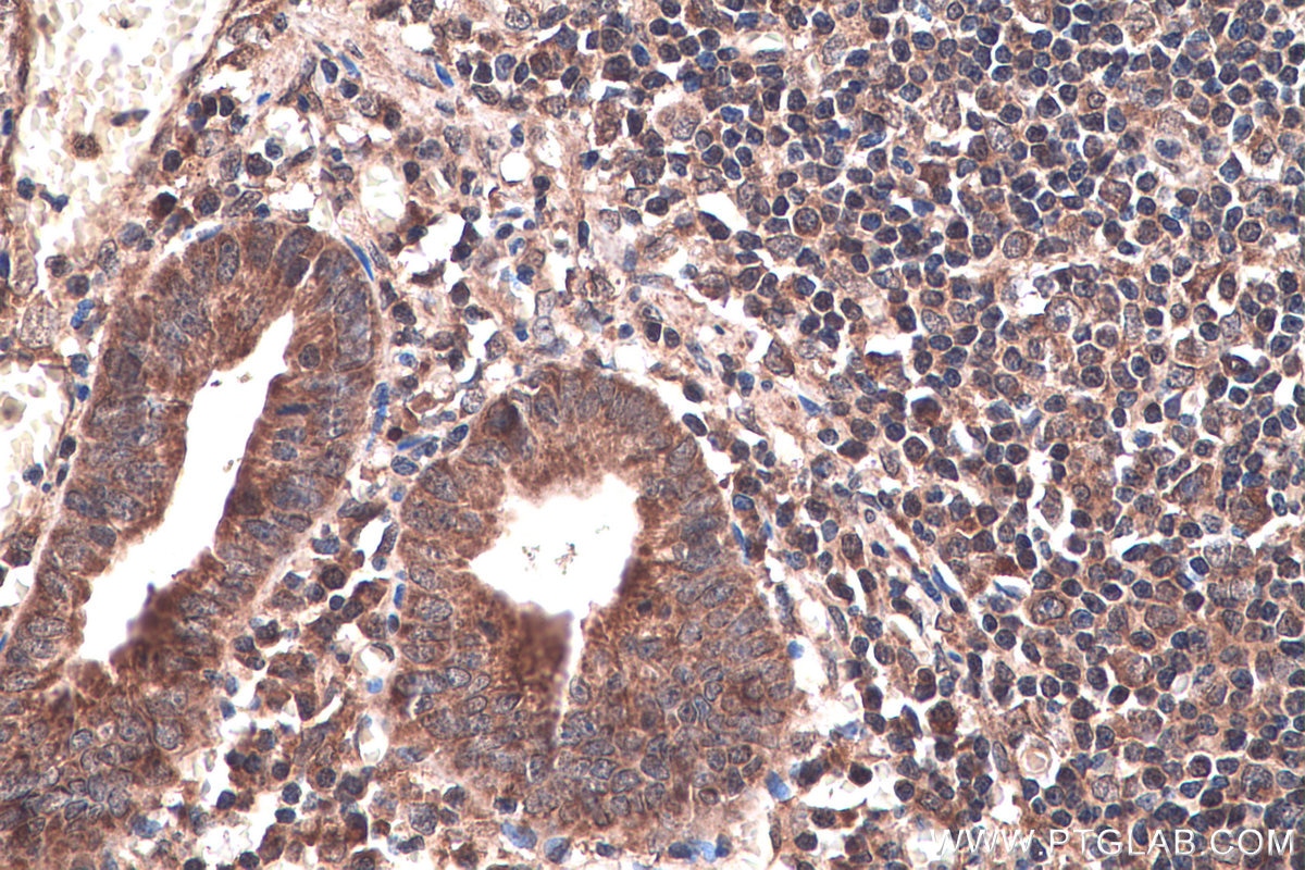 Immunohistochemical analysis of paraffin-embedded human appendicitis tissue slide using KHC0373 (Cathepsin B IHC Kit).