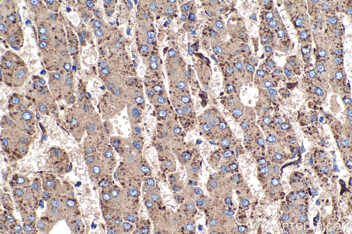 Immunohistochemical analysis of paraffin-embedded human liver cancer tissue slide using KHC0374 (Cathepsin D IHC Kit).
