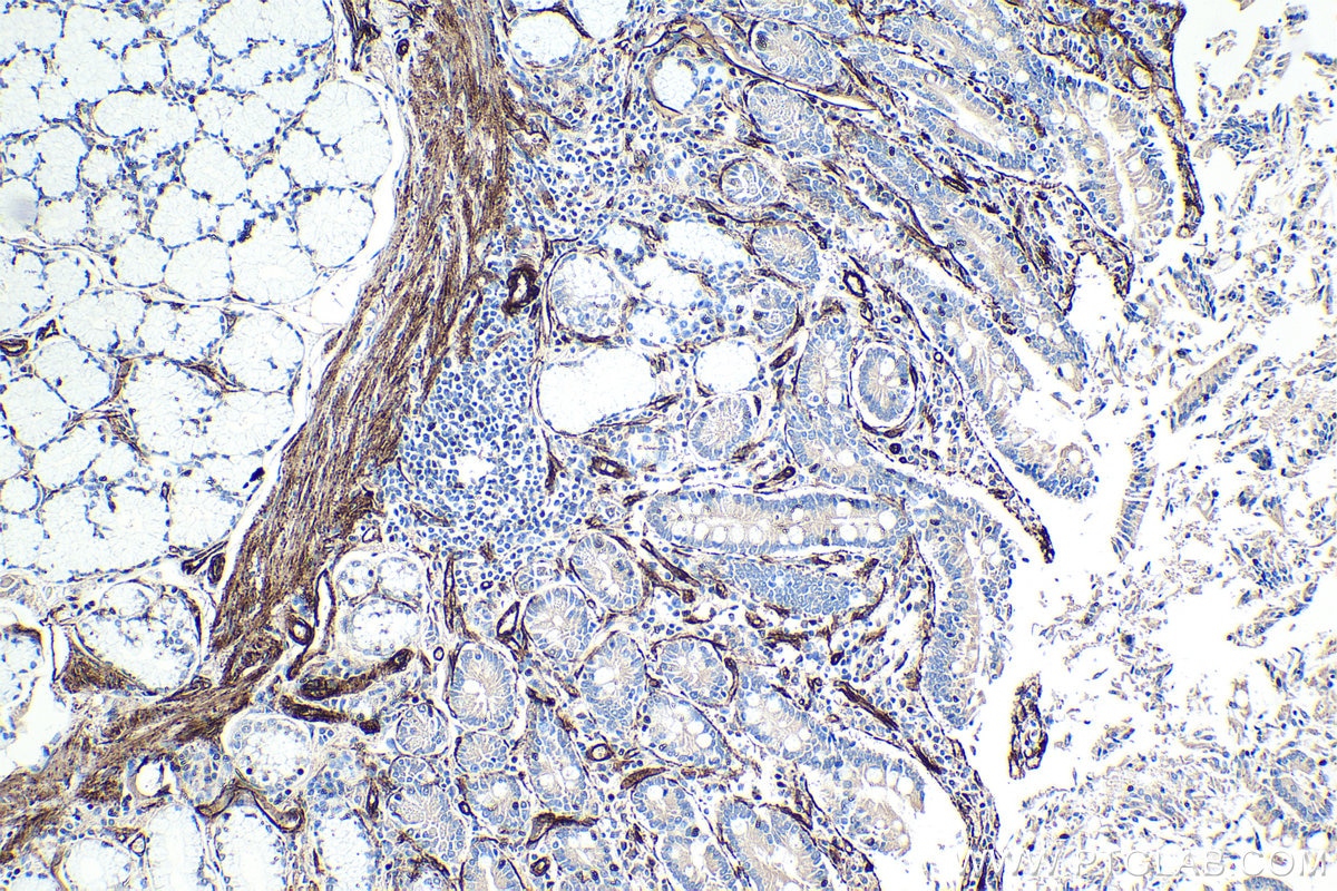 Immunohistochemical analysis of paraffin-embedded human stomach cancer tissue slide using KHC1326 (Caveolin-1 IHC Kit).