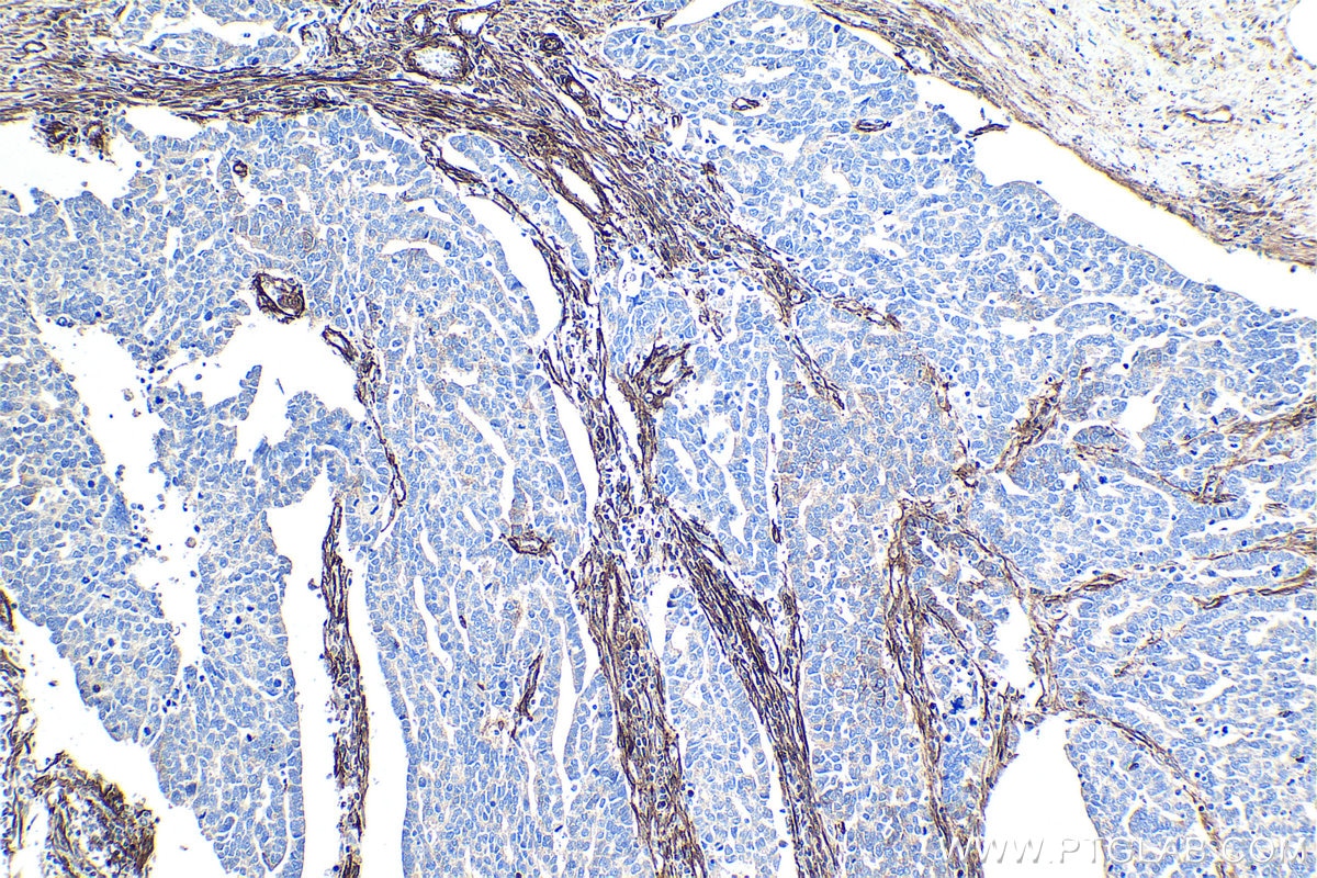 Immunohistochemical analysis of paraffin-embedded human ovary tumor tissue slide using KHC1326 (Caveolin-1 IHC Kit).