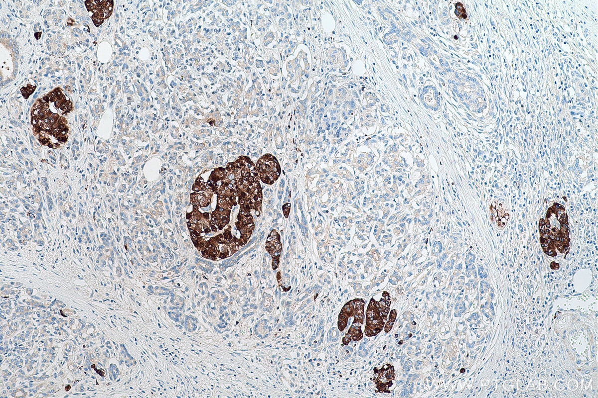 Immunohistochemical analysis of paraffin-embedded human pancreas cancer tissue slide using KHC0602 (CgA/CHGA IHC Kit).