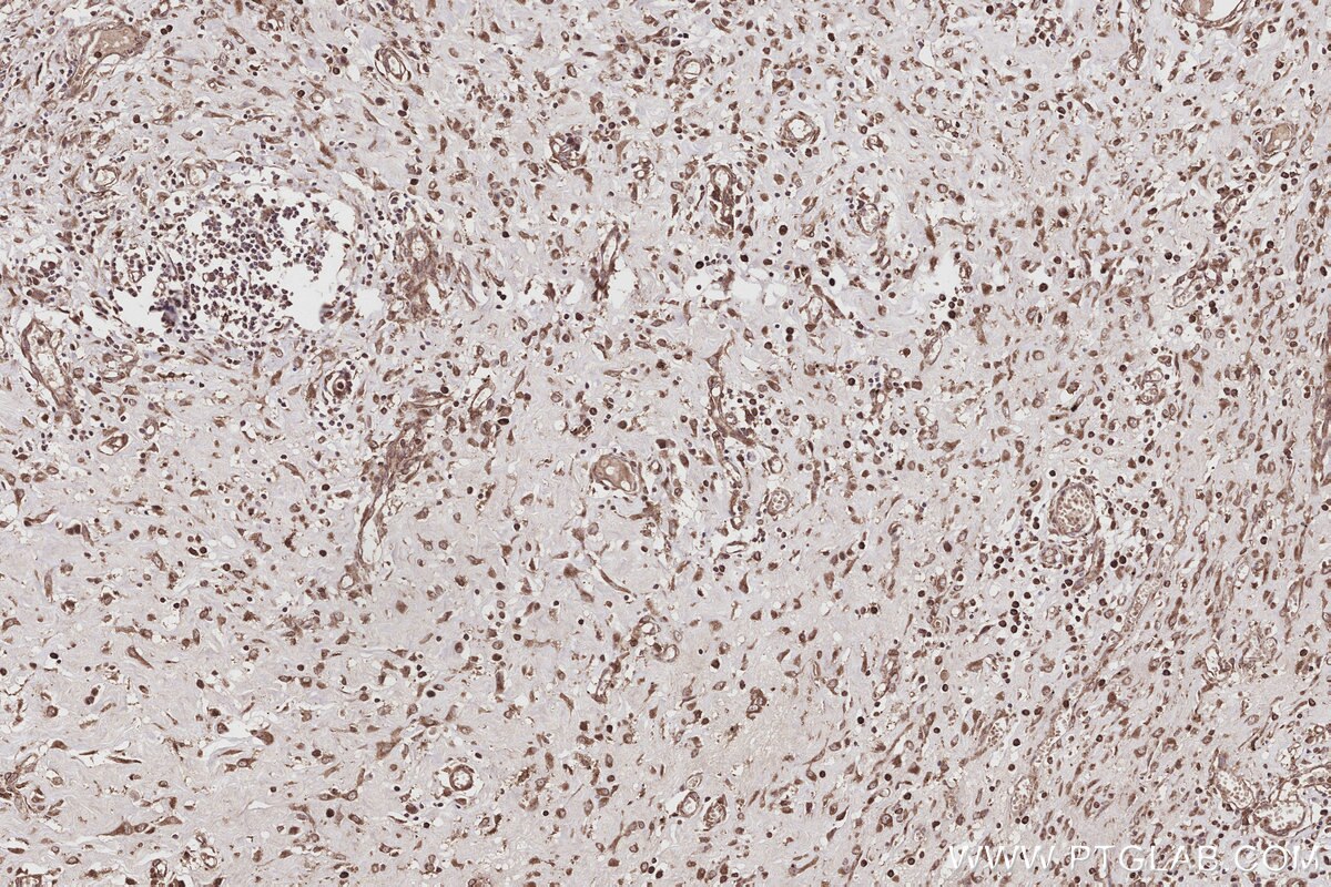 Immunohistochemical analysis of paraffin-embedded human colon cancer tissue slide using KHC3190 (Cytochrome P450 IHC Kit).