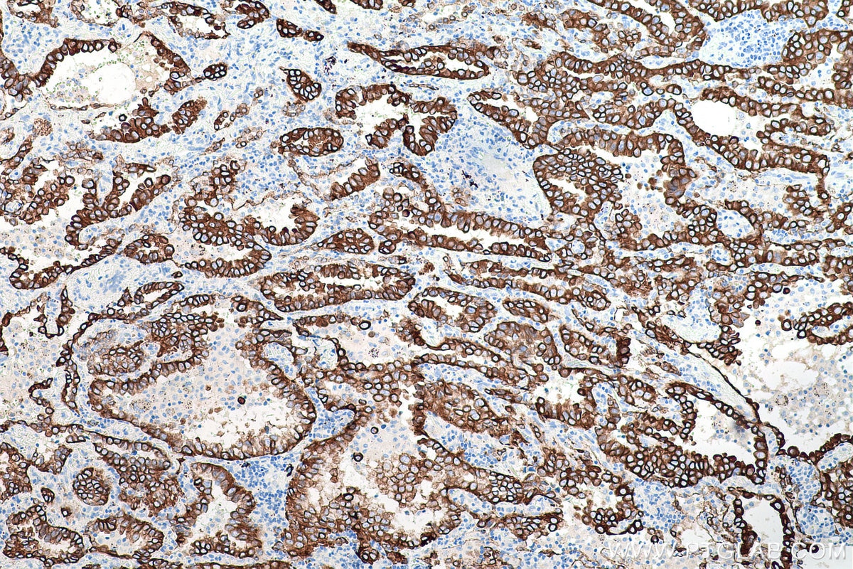 Immunohistochemical analysis of paraffin-embedded human lung cancer tissue slide using KHC0204 (Cytokeratin 7 IHC Kit).