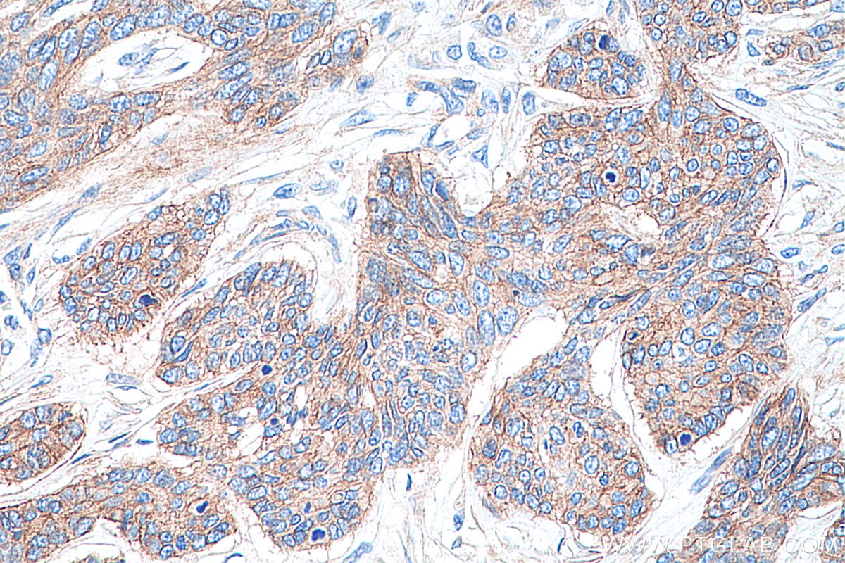 Immunohistochemical analysis of paraffin-embedded human skin cancer tissue slide using KHC0285 (DAG1 IHC Kit).