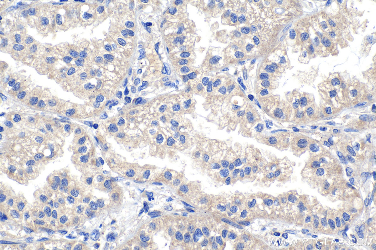 Immunohistochemical analysis of paraffin-embedded human lung cancer tissue slide using KHC1079 (DAPK1 IHC Kit).