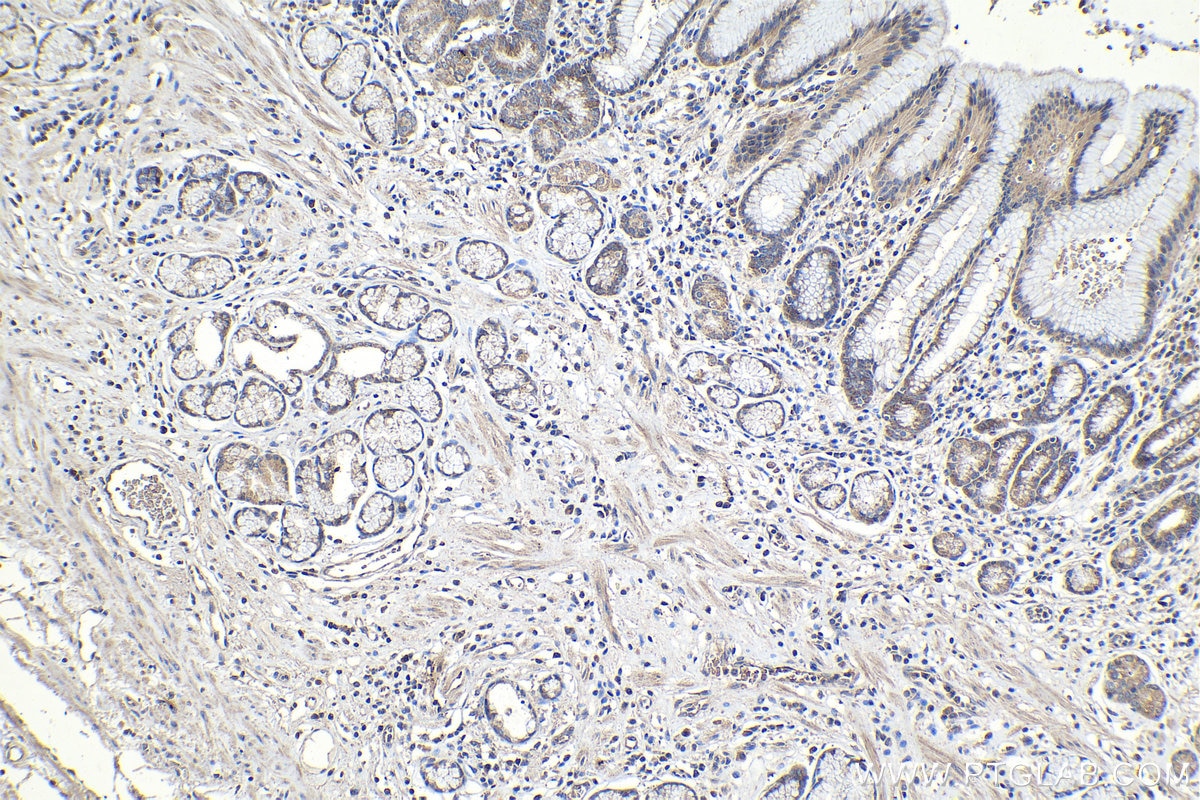 Immunohistochemical analysis of paraffin-embedded human stomach cancer tissue slide using KHC1079 (DAPK1 IHC Kit).