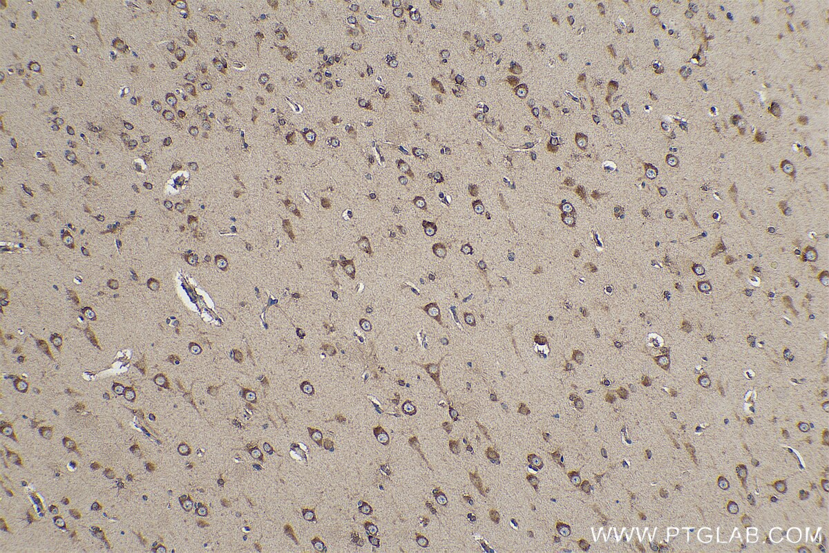 Immunohistochemical analysis of paraffin-embedded human gliomas tissue slide using KHC0843 (DARS IHC Kit).