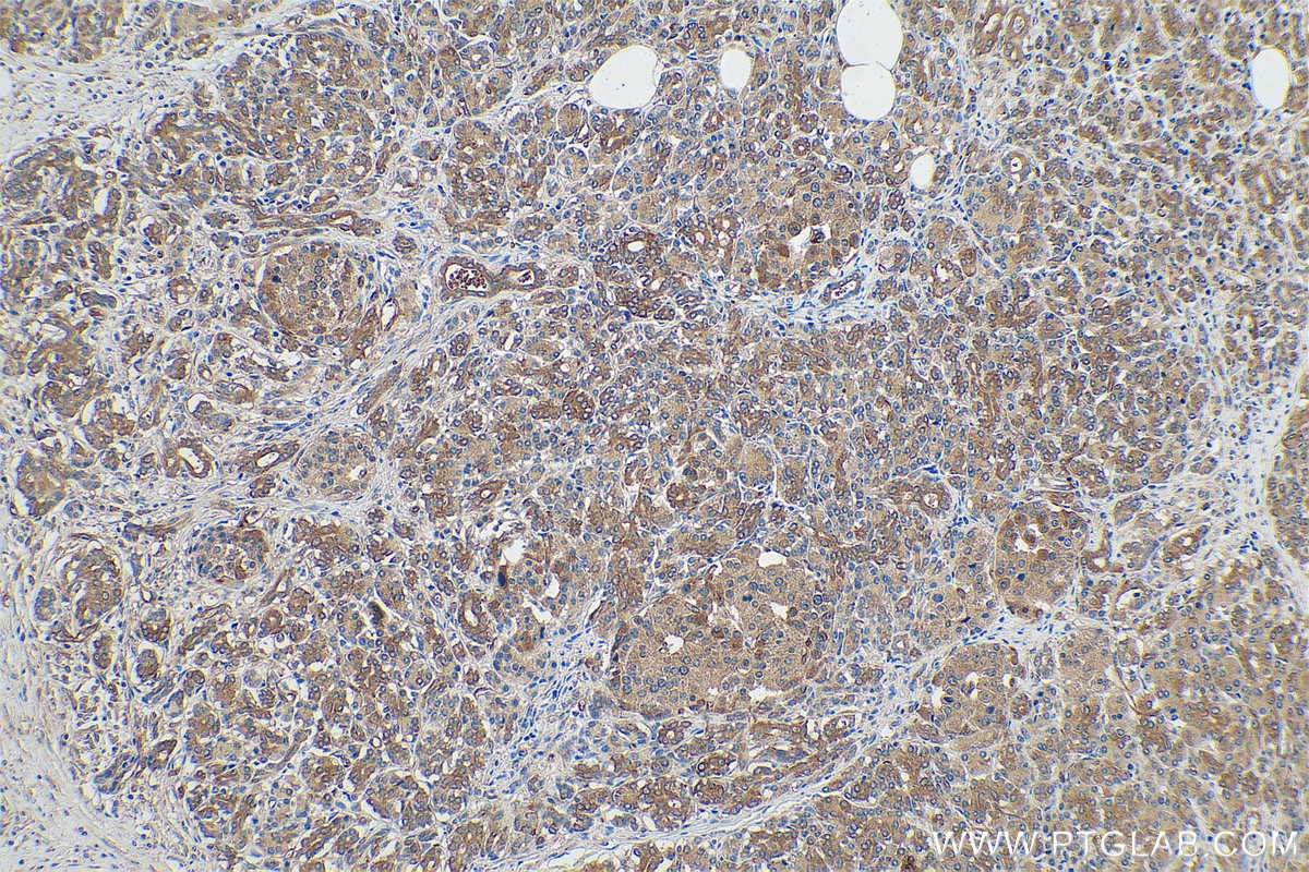 Immunohistochemical analysis of paraffin-embedded human pancreas cancer tissue slide using KHC0843 (DARS IHC Kit).