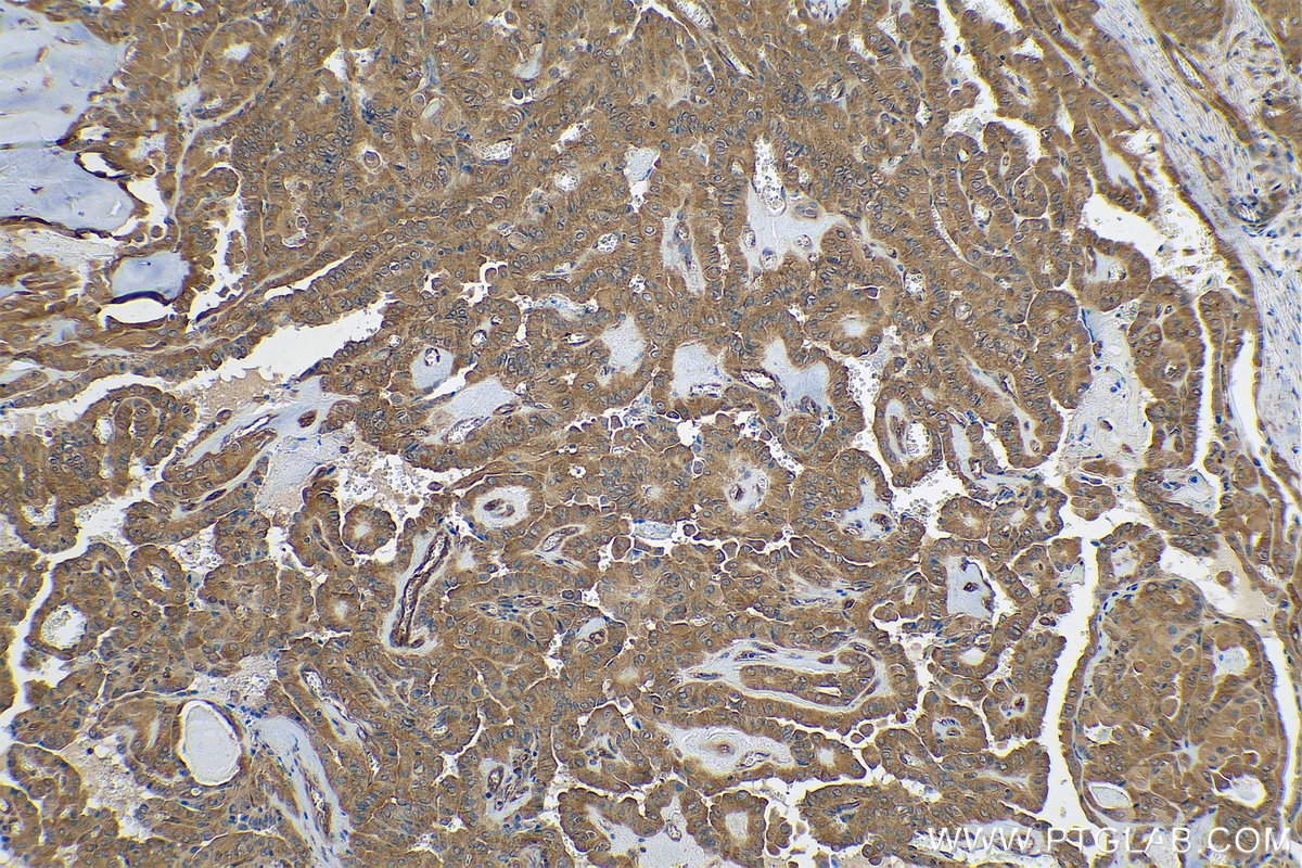 Immunohistochemical analysis of paraffin-embedded human thyroid cancer tissue slide using KHC0843 (DARS IHC Kit).