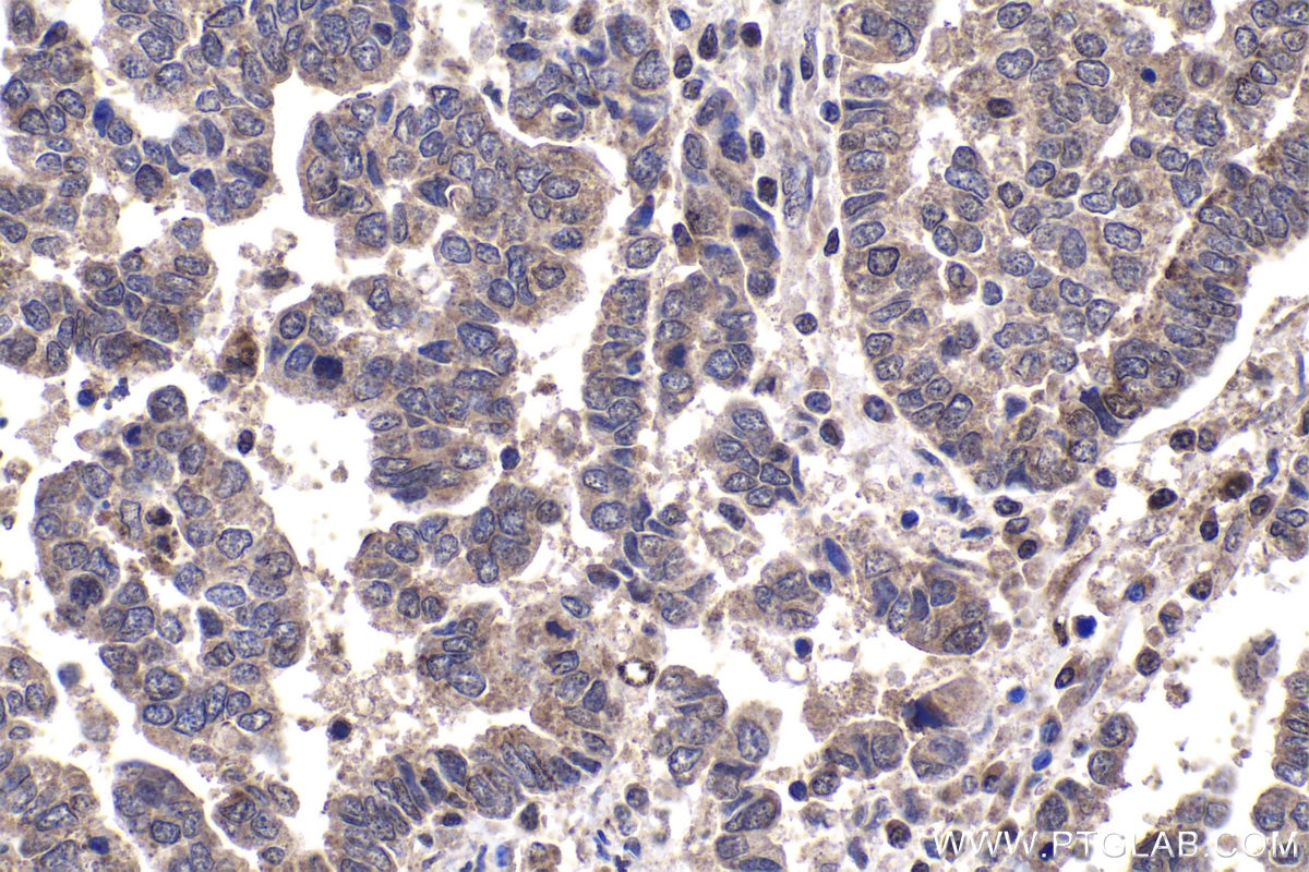 Immunohistochemical analysis of paraffin-embedded human ovary tumor tissue slide using KHC1977 (DAXX IHC Kit).