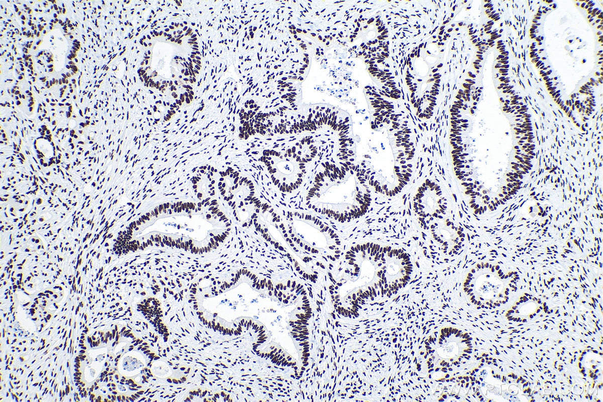 Immunohistochemical analysis of paraffin-embedded human colon cancer tissue slide using KHC0242 (DBC1/CCAR2 IHC Kit).