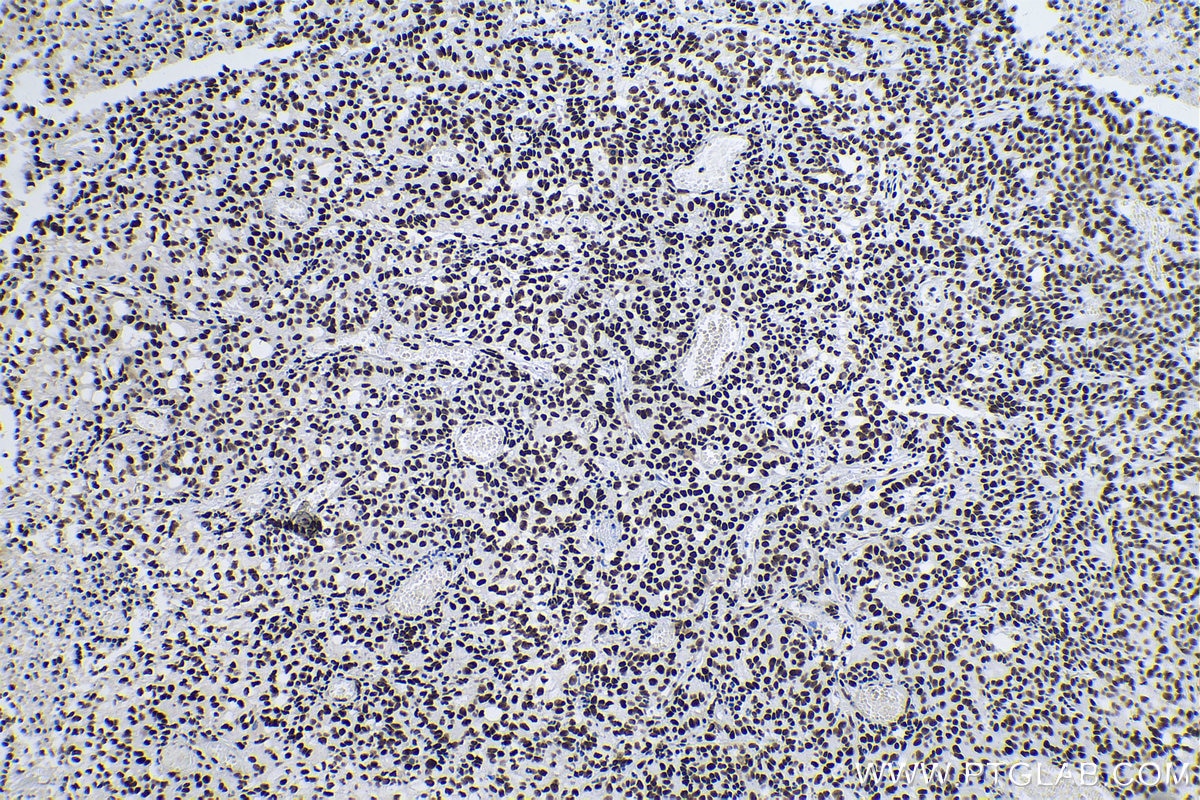 Immunohistochemical analysis of paraffin-embedded human stomach cancer tissue slide using KHC0242 (DBC1/CCAR2 IHC Kit).